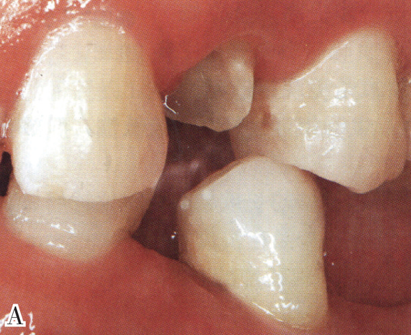 牙体严重缺损前牙根管治疗后的修复黄翠教授