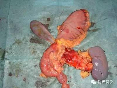 胰腺癌出现红斑的图片图片