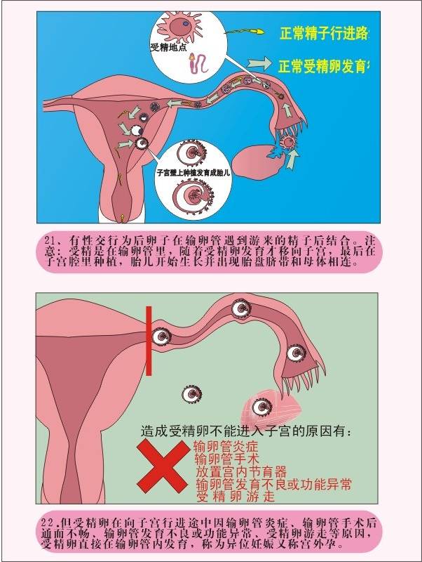 宫外孕图片示意图腹部图片