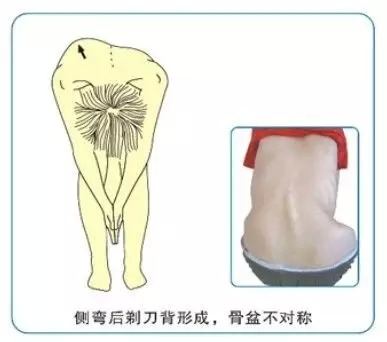 什麼是胸椎側彎