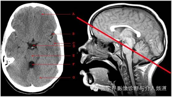 带着备注来帮你看懂大脑ct图谱