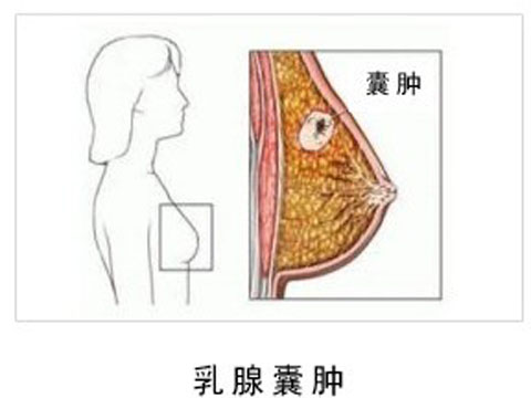 乳腺囊肿怎么引起的图片