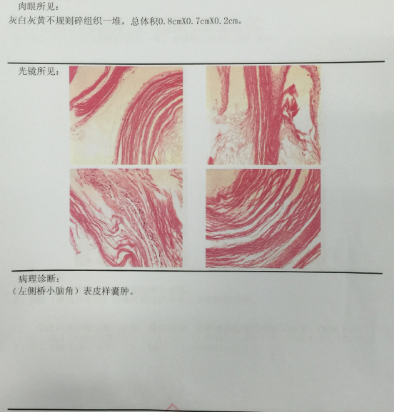 桥小脑角区表皮样囊肿图片