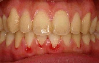 牙菌斑图片,什么是牙菌斑