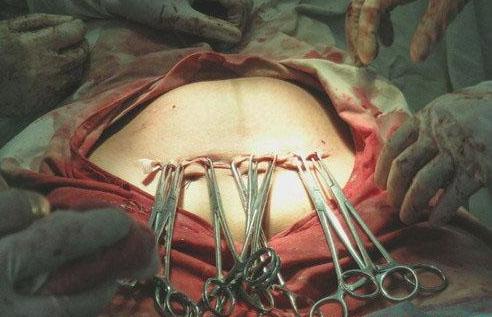 手术生孩子肚子图片