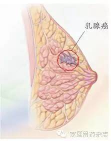 乳腺癌早期能治愈吗图片