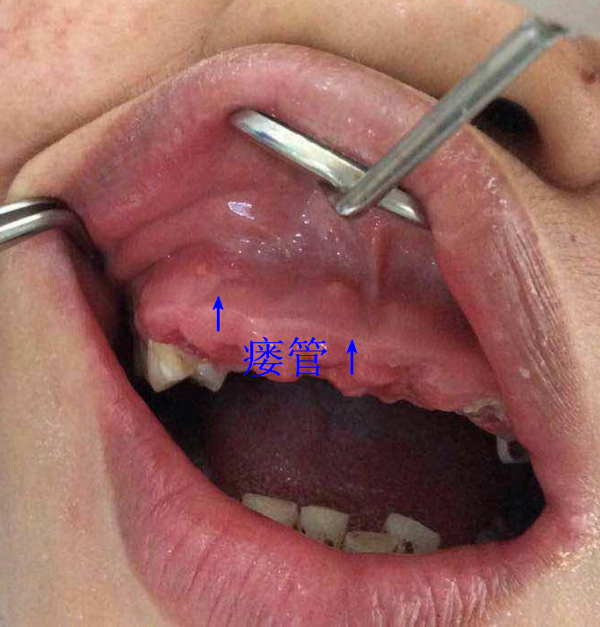 牙龈瘘管口腔图片
