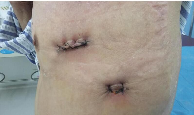 图1 单操作孔胸腔镜手术术后伤口外观(术后第4天)图2 切下的肺大泡