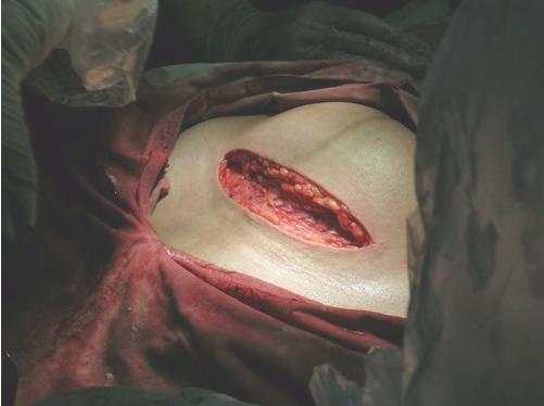 剖腹产手术实拍图片