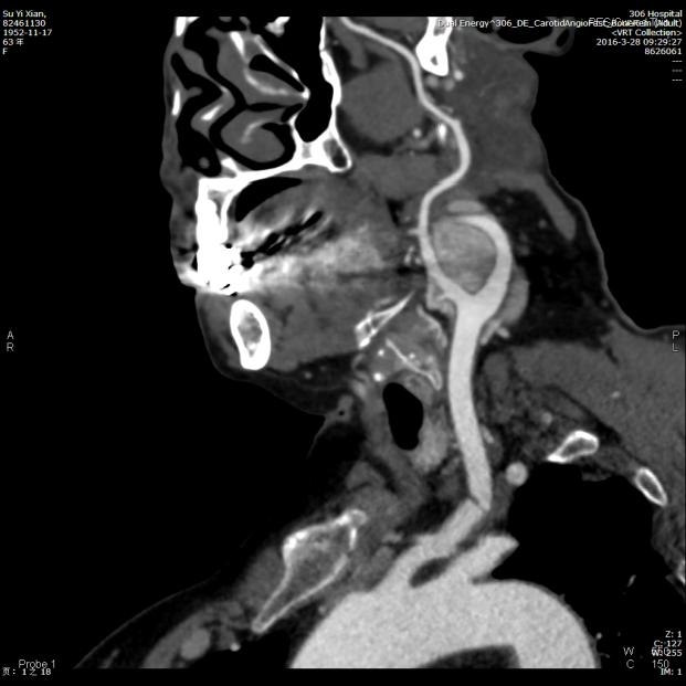 颈动脉鞘区肿瘤图片
