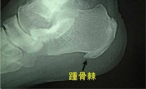 骨刺长在哪里图片图片