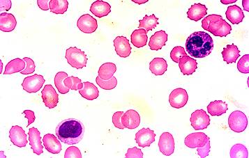 图 12 棘形红细胞三,颜色正常的中央淡染区约为 rbc 直径 1/3
