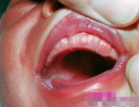 马牙不是病,马牙不影响婴儿吃奶和乳牙的发育,它在出生后的数月