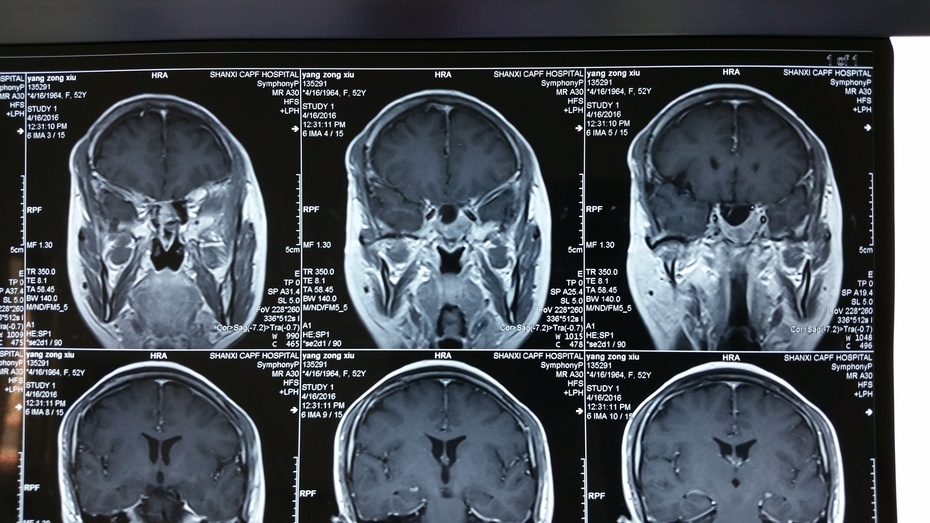 (最新)賀曉生教授病例追蹤垂體瘤經蝶手術切除