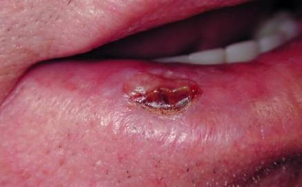 下嘴唇癌早期症状图片图片