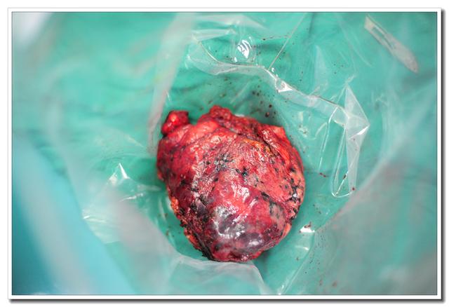 肺癌咳出肿瘤组织图片图片