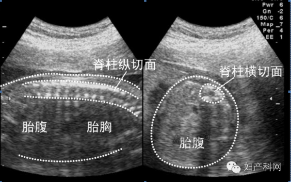2,脊柱矢状切面1,丘脑水平横切面三,存取图片(超声胎儿生长参数评估