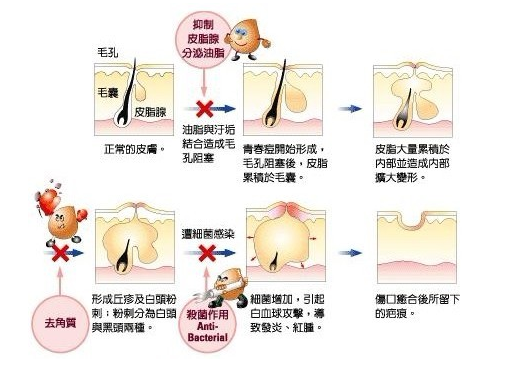 黑头形成的原因有哪些