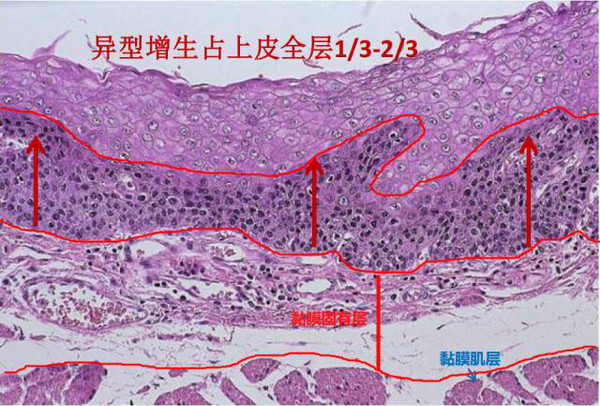 异型细胞局限在上皮层的下三分之一为轻度异型增生(低级别上皮内瘤变)