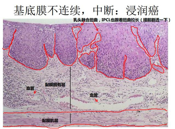 箭头处看到两三个肿瘤细胞呈簇状漂浮在固有层,这就是浸润的表现