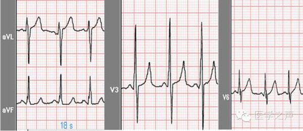 心电图特征:心率96次/分,p