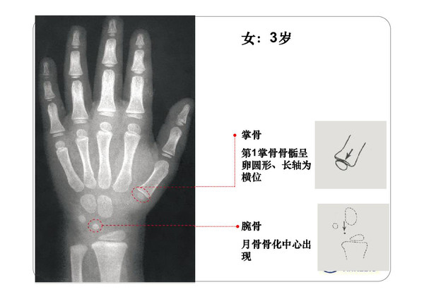 骨龄片子怎么看左手图片