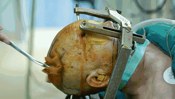 20张gif图全解脑深部电刺激手术过程