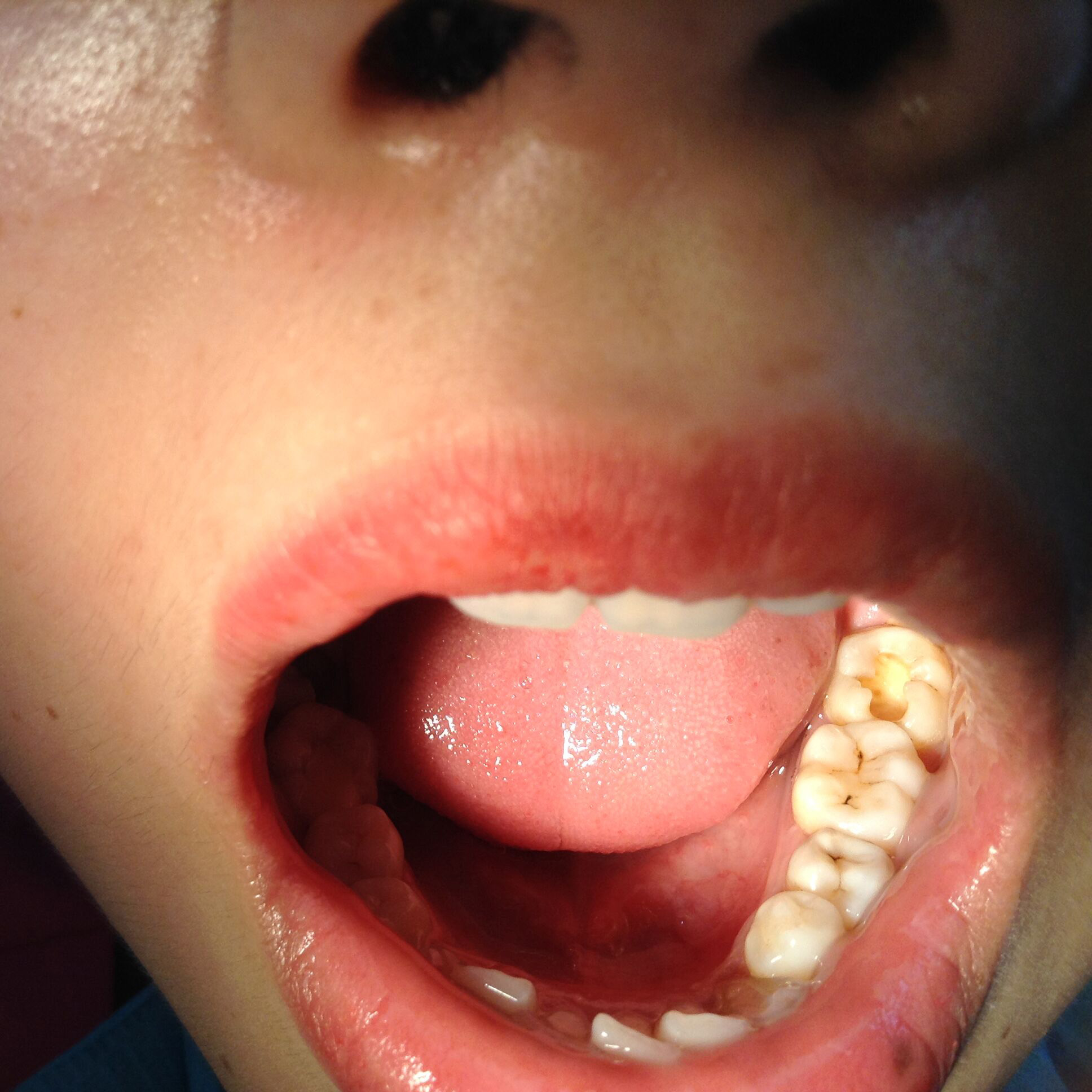 前牙龋齿图片