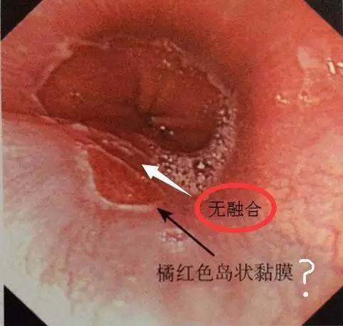 食道 齿状线图片