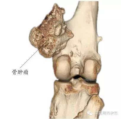 不可忽视的四肢关节痛起病隐匿危害巨大的骨肿瘤蔡郑东教授