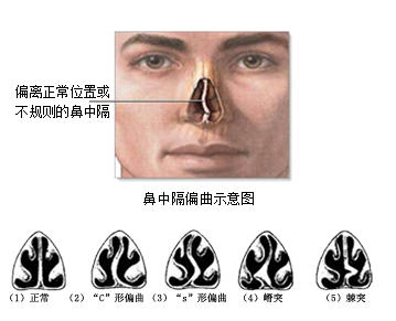 鼻中隔黎氏区解剖图图片