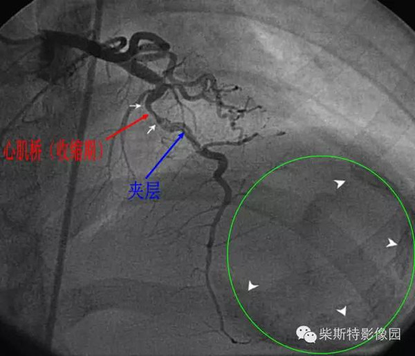 有了这些图解还怕看不穿冠状动脉心肌桥