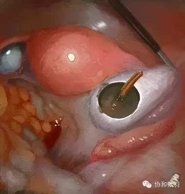 卵巢囊肿10公分图片图片