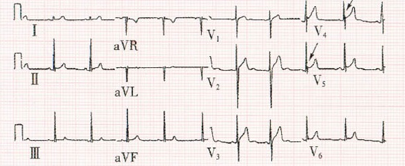 心电图st段抬高,可能是这些疾病!