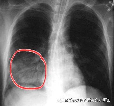 大叶性肺炎x线表现图片