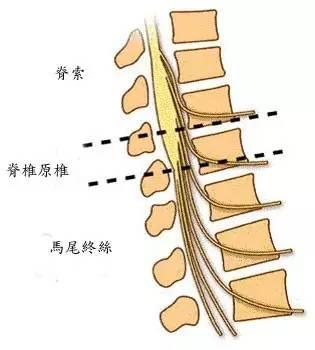 腰椎間盤突出症會遺傳?嚇死寶寶了