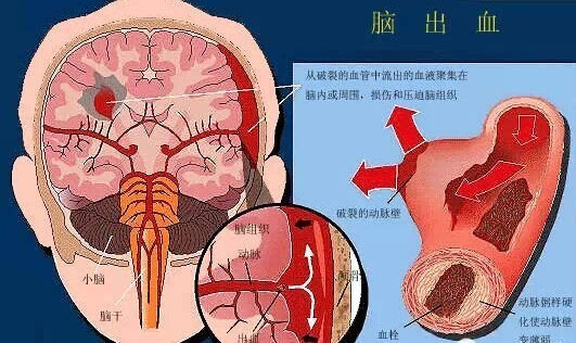 导致脑出血的几种原因