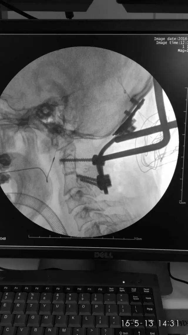 再行后路复位枕颈融合术vsp回顾共四台脊柱手术