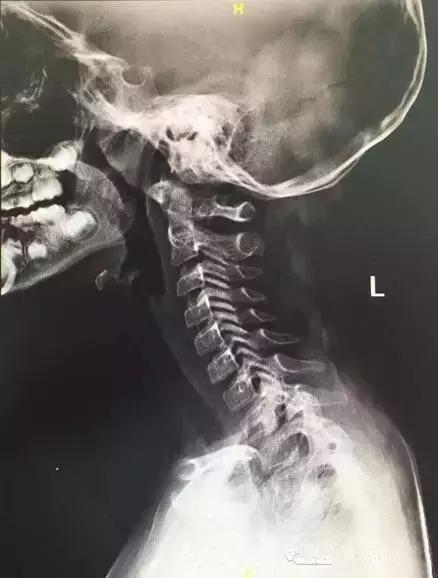 颈椎断裂图片