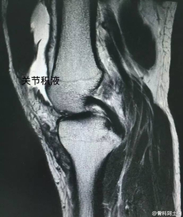 膝关节积液核磁图片