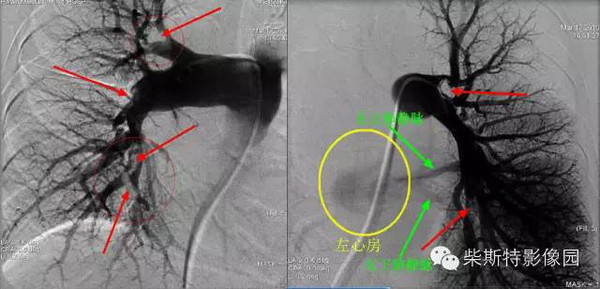 第一大名捕:肺动脉造影肺栓塞(pe)是内源性或外源性栓子堵塞肺动脉或