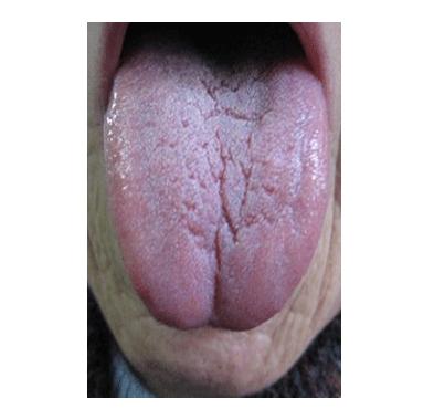 肾阴虚舌头的图片图片