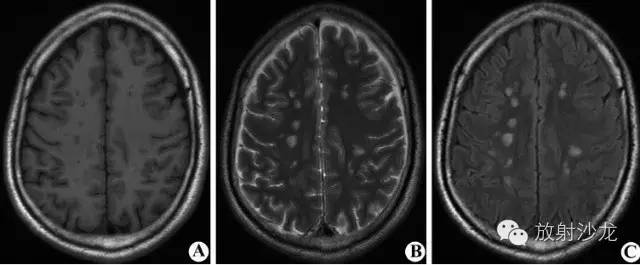 雙側幕上半球放射冠區多發斑片狀異常信號區.