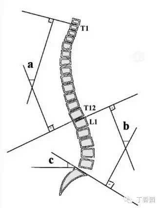 腰椎前凸角度测量图片