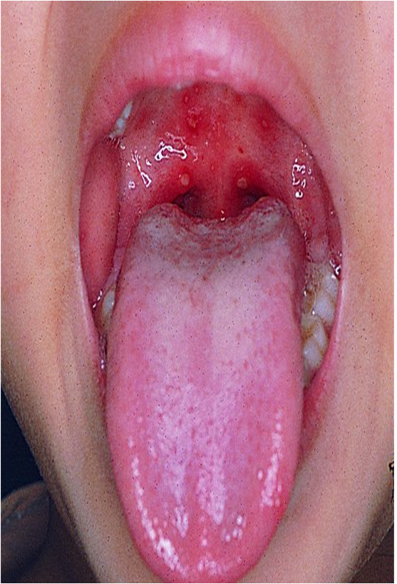 成人咽峡炎疱疹图片图片