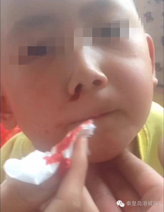 小朋友鼻子受伤的图片图片