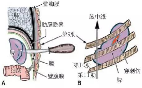 第五肋间隙图片