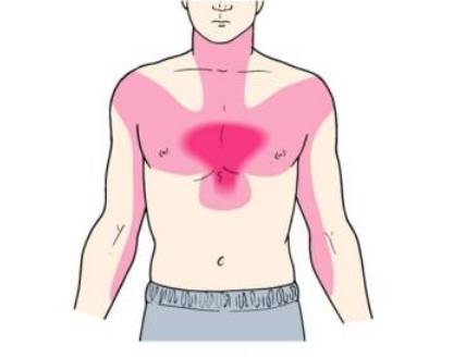 范围:心绞痛引起的疼痛范围模糊,由于心脏没有感觉神经,患者常以手掌