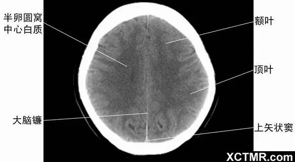 详细!带标注的颅脑ct解剖
