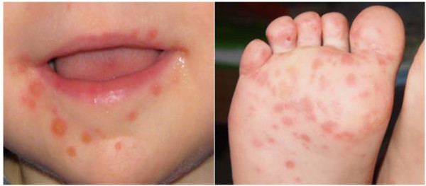十一,风疹,麻疹,玫瑰疹(从左到右顺序)比较欢迎投稿到小编邮箱:zhao